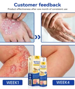 ADFIRE™ PsoriaHeal Bee poison Psoriasis Spray