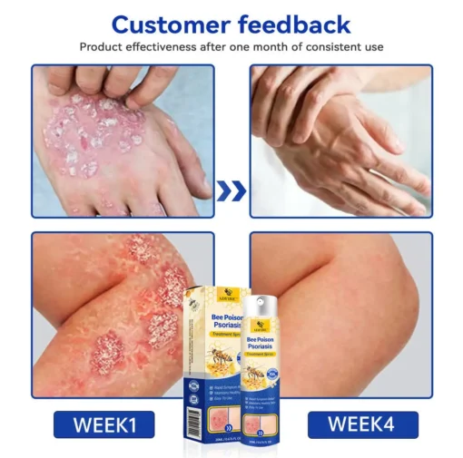 ADFIRE™ PsoriaHeal Bee poison Psoriasis Spray